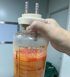 大连水动力吸脂手术要做多久？